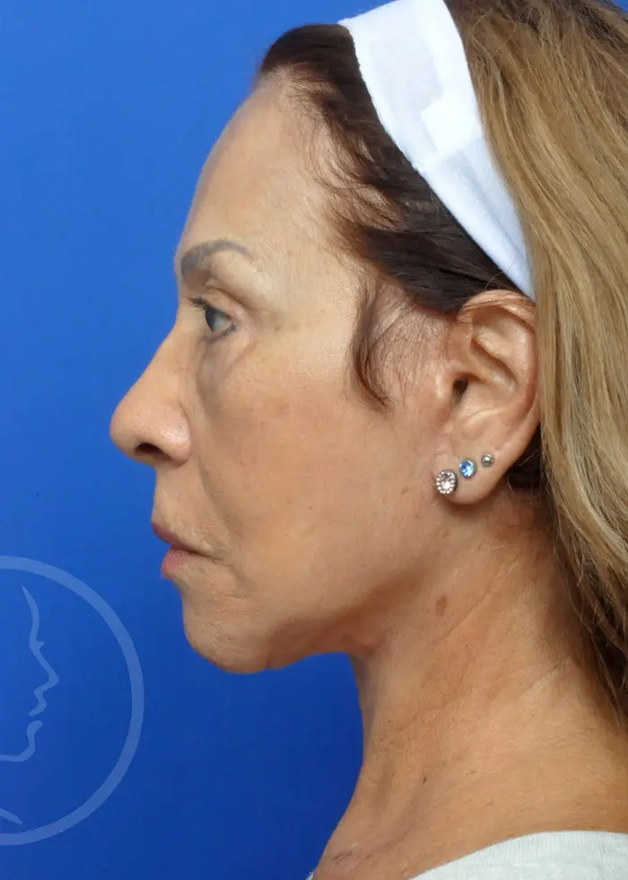 Plastic Surgery Before and After Pictures in Jacksonville, FL - Garcia Facial Plastic Surgery