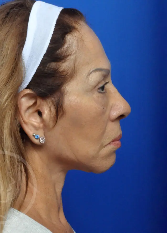 Plastic Surgery Before and After Pictures in Jacksonville, FL - Garcia Facial Plastic Surgery
