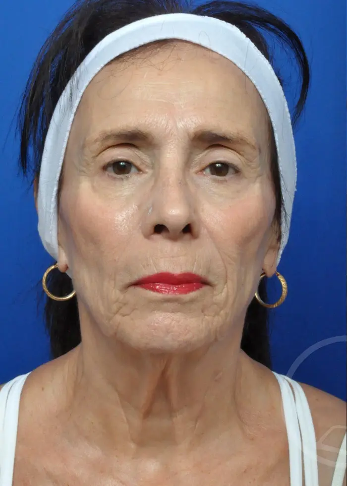 Plastic Surgery Before and After Pictures in Jacksonville, FL - Garcia Facial Plastic Surgery