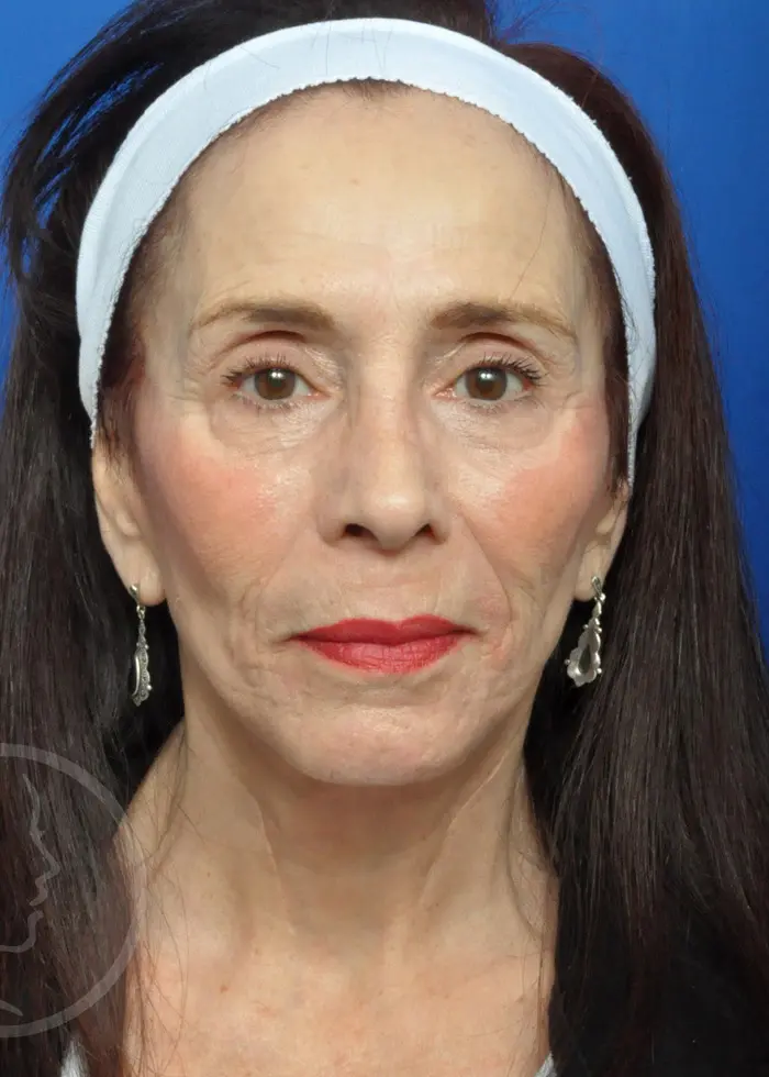 Plastic Surgery Before and After Pictures in Jacksonville, FL - Garcia Facial Plastic Surgery