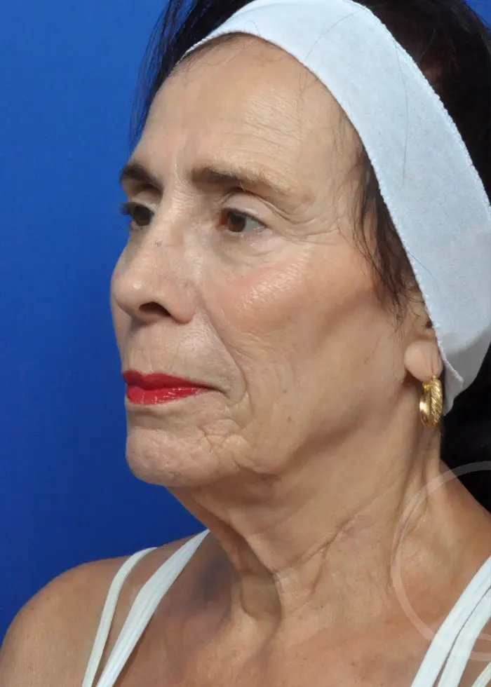 Plastic Surgery Before and After Pictures in Jacksonville, FL - Garcia Facial Plastic Surgery