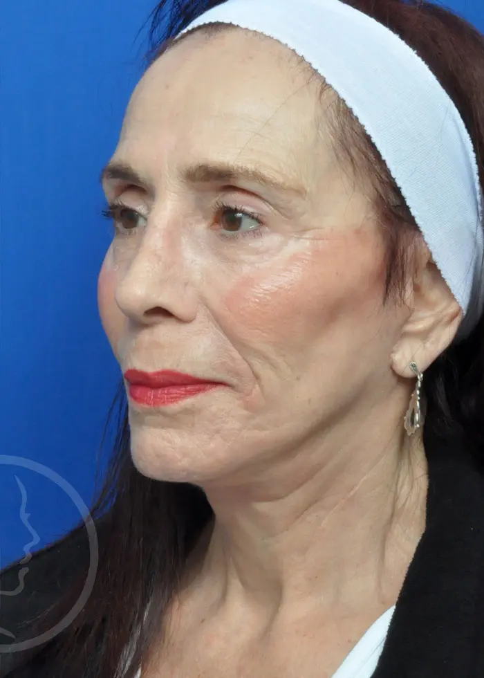 Plastic Surgery Before and After Pictures in Jacksonville, FL - Garcia Facial Plastic Surgery