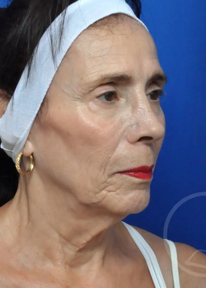 Plastic Surgery Before and After Pictures in Jacksonville, FL - Garcia Facial Plastic Surgery