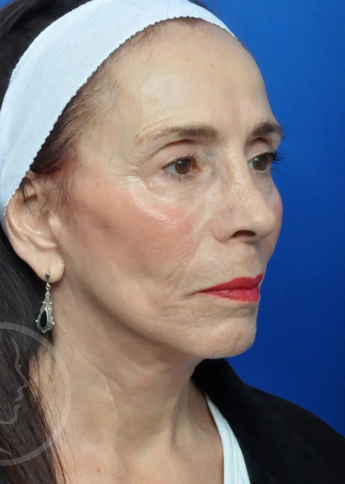 Plastic Surgery Before and After Pictures in Jacksonville, FL - Garcia Facial Plastic Surgery