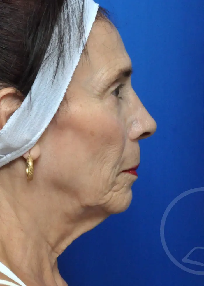 Plastic Surgery Before and After Pictures in Jacksonville, FL - Garcia Facial Plastic Surgery