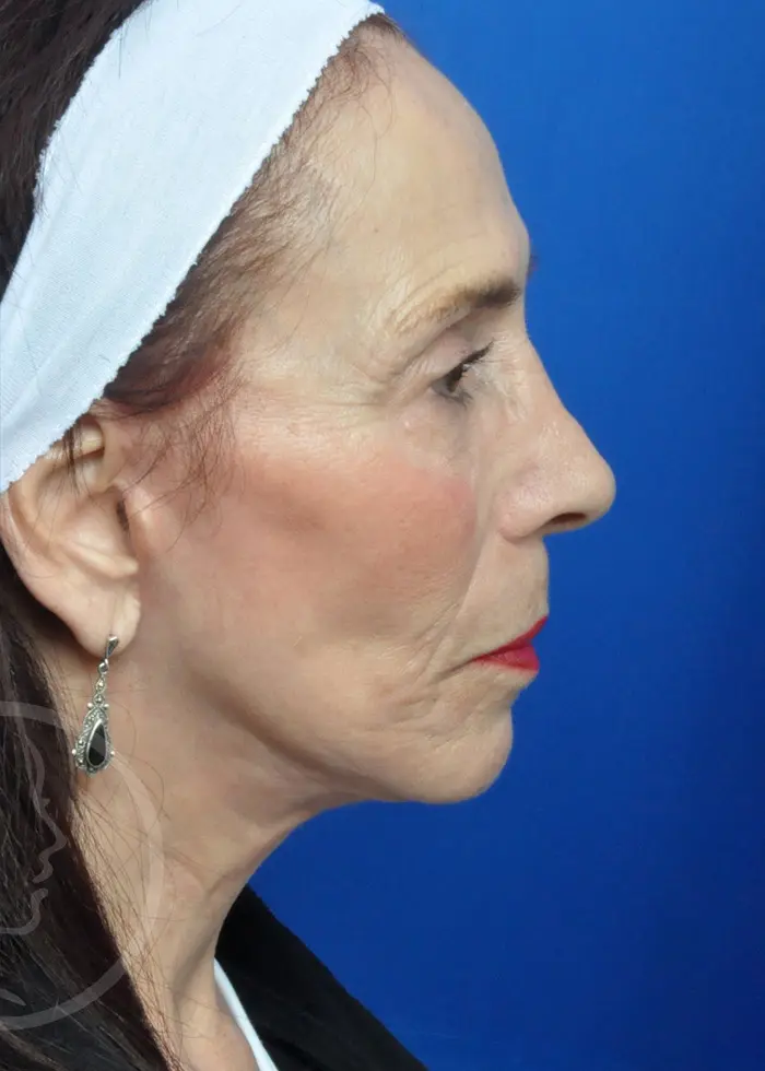 Plastic Surgery Before and After Pictures in Jacksonville, FL - Garcia Facial Plastic Surgery