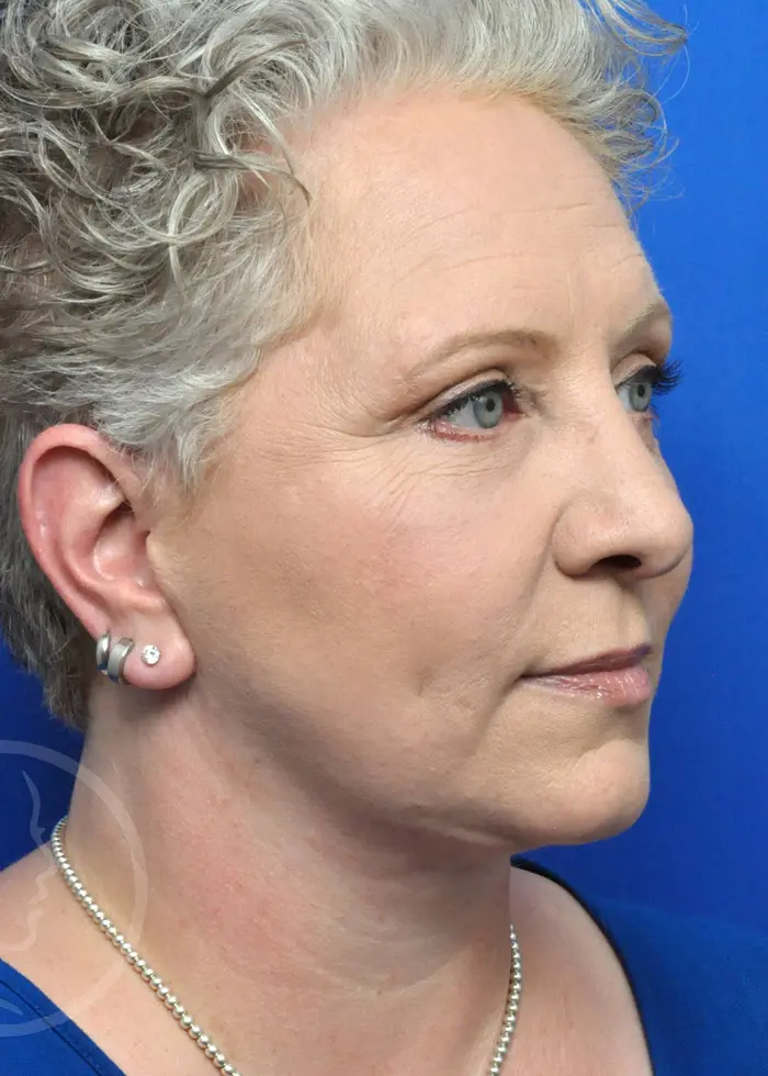 Plastic Surgery Before and After Pictures in Jacksonville, FL - Garcia Facial Plastic Surgery