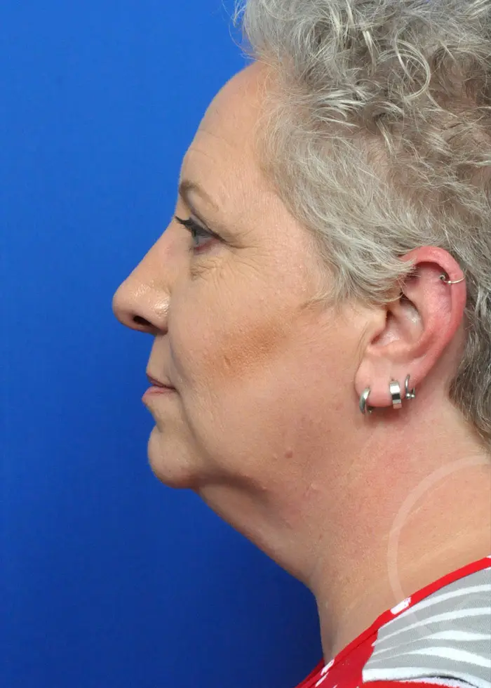 Plastic Surgery Before and After Pictures in Jacksonville, FL - Garcia Facial Plastic Surgery
