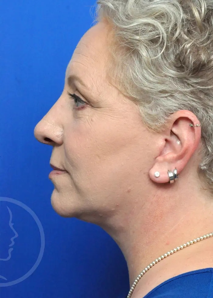 Plastic Surgery Before and After Pictures in Jacksonville, FL - Garcia Facial Plastic Surgery