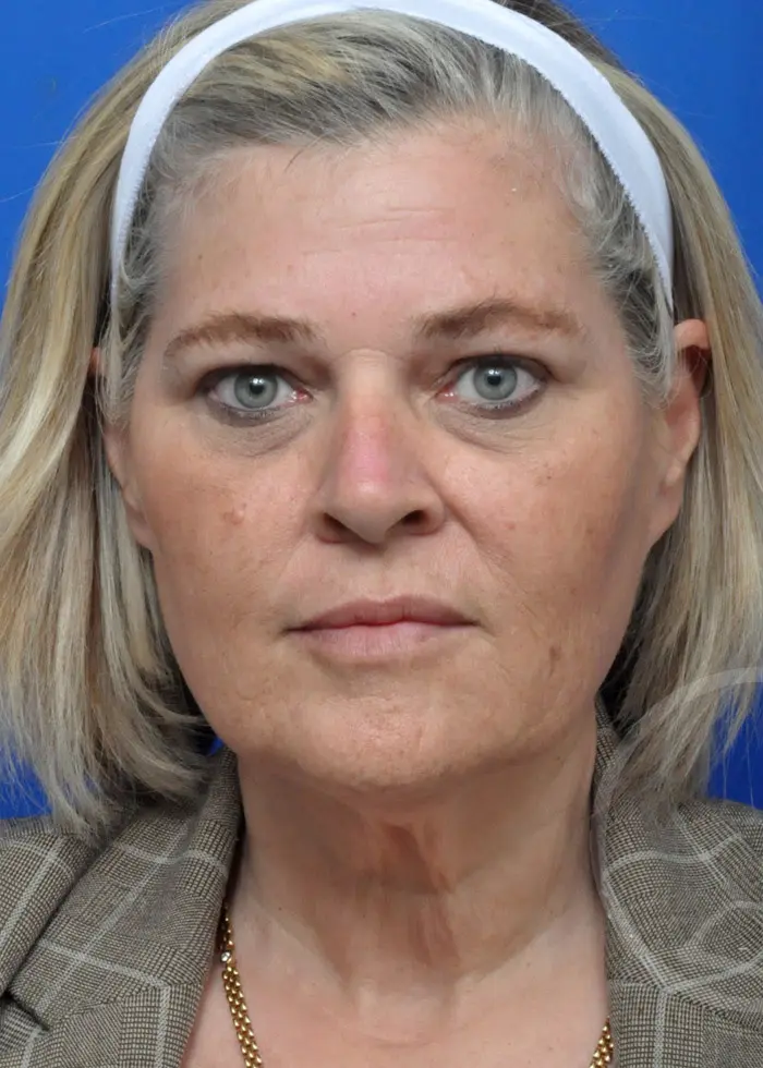 Plastic Surgery Before and After Pictures in Jacksonville, FL - Garcia Facial Plastic Surgery