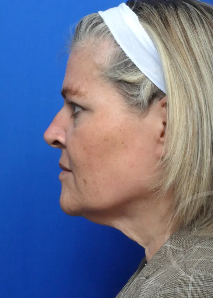 Plastic Surgery Before and After Pictures in Jacksonville, FL - Garcia Facial Plastic Surgery