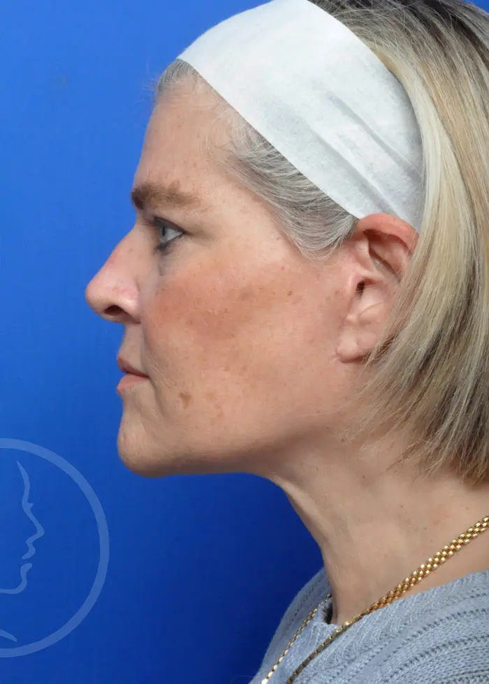 Plastic Surgery Before and After Pictures in Jacksonville, FL - Garcia Facial Plastic Surgery