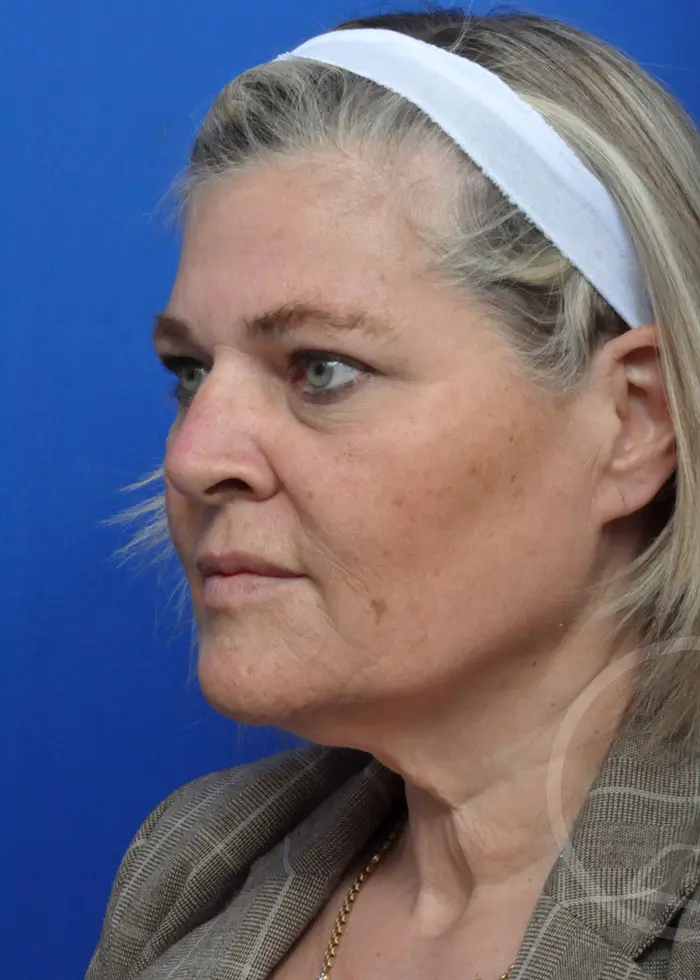 Plastic Surgery Before and After Pictures in Jacksonville, FL - Garcia Facial Plastic Surgery
