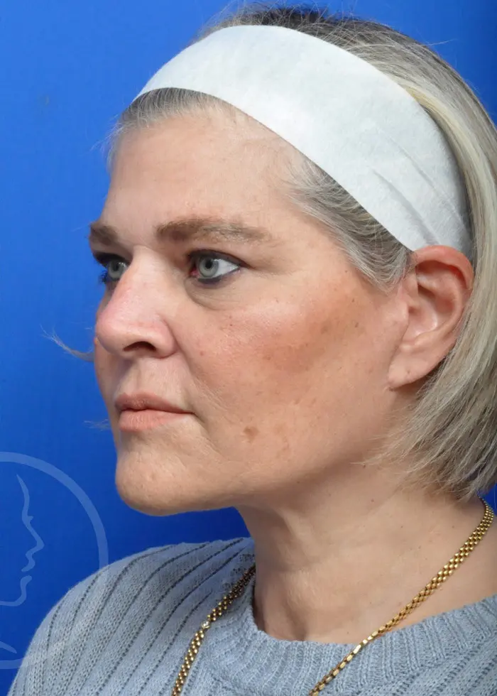 Plastic Surgery Before and After Pictures in Jacksonville, FL - Garcia Facial Plastic Surgery