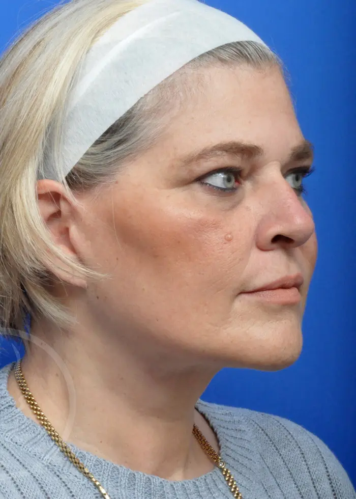 Plastic Surgery Before and After Pictures in Jacksonville, FL - Garcia Facial Plastic Surgery