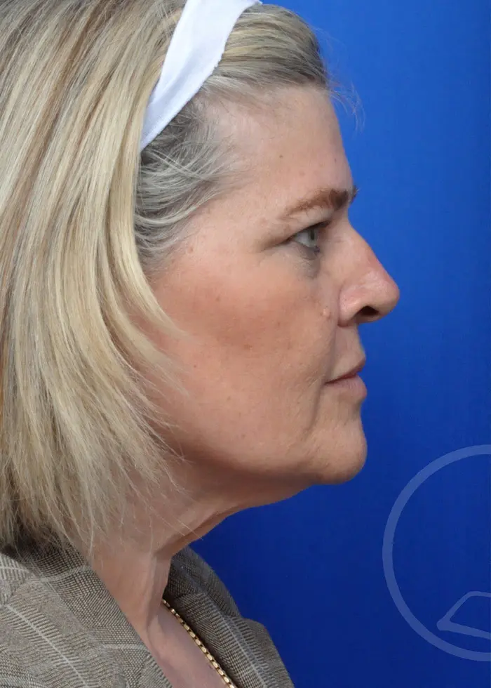 Plastic Surgery Before and After Pictures in Jacksonville, FL - Garcia Facial Plastic Surgery