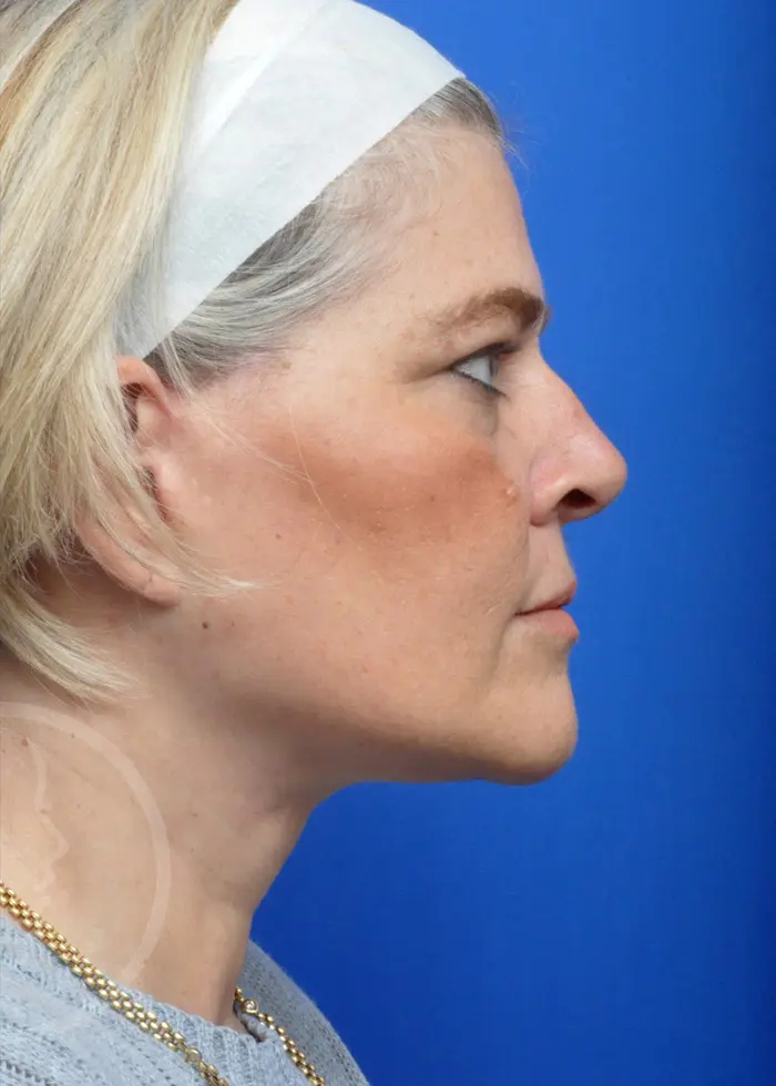 Plastic Surgery Before and After Pictures in Jacksonville, FL - Garcia Facial Plastic Surgery