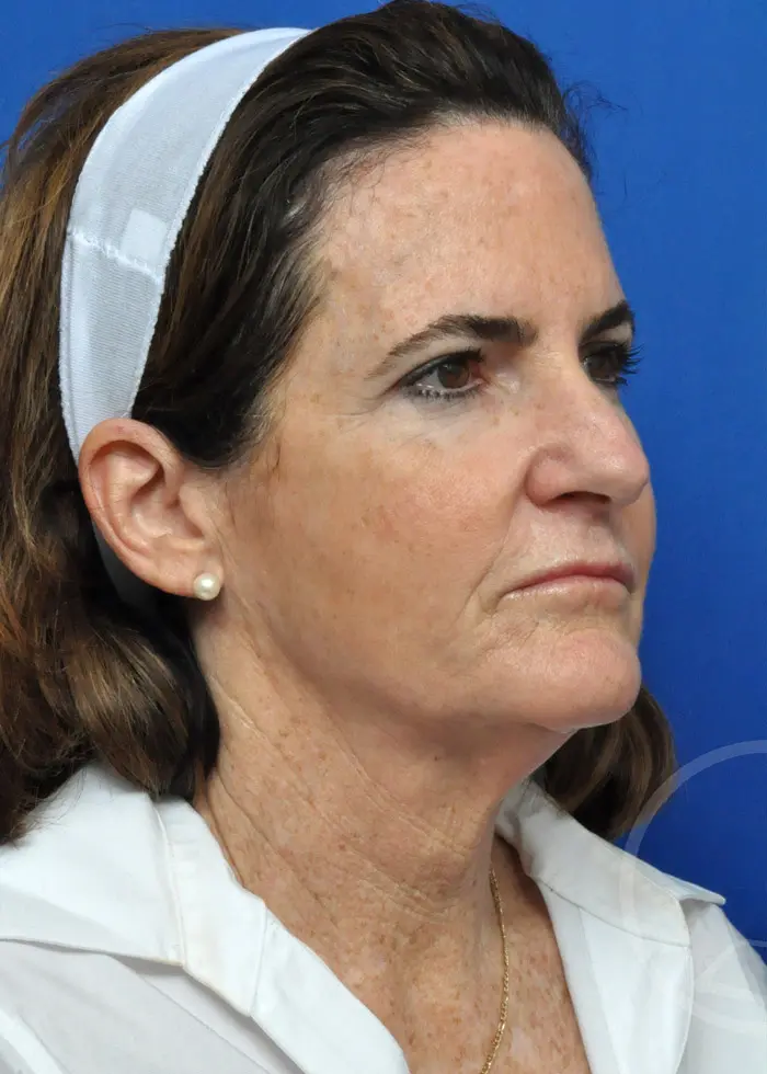 Plastic Surgery Before and After Pictures in Jacksonville, FL - Garcia Facial Plastic Surgery