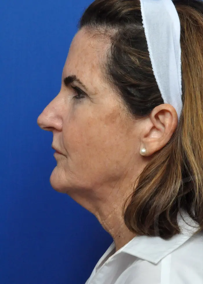 Plastic Surgery Before and After Pictures in Jacksonville, FL - Garcia Facial Plastic Surgery