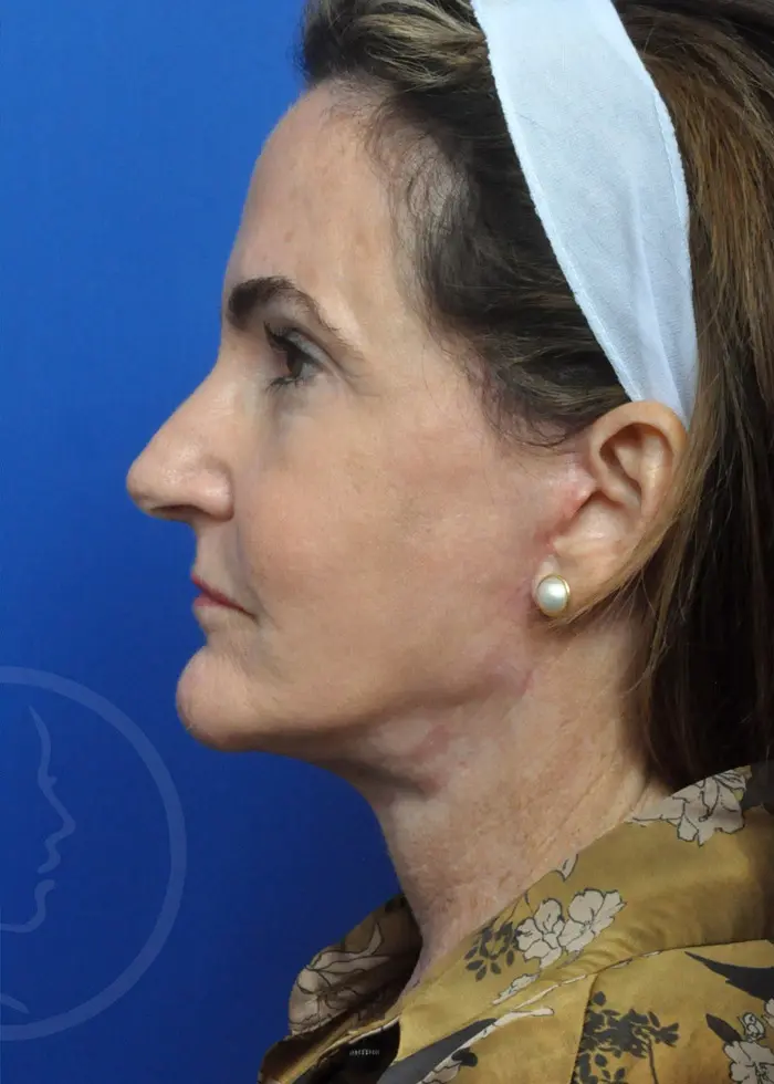 Plastic Surgery Before and After Pictures in Jacksonville, FL - Garcia Facial Plastic Surgery