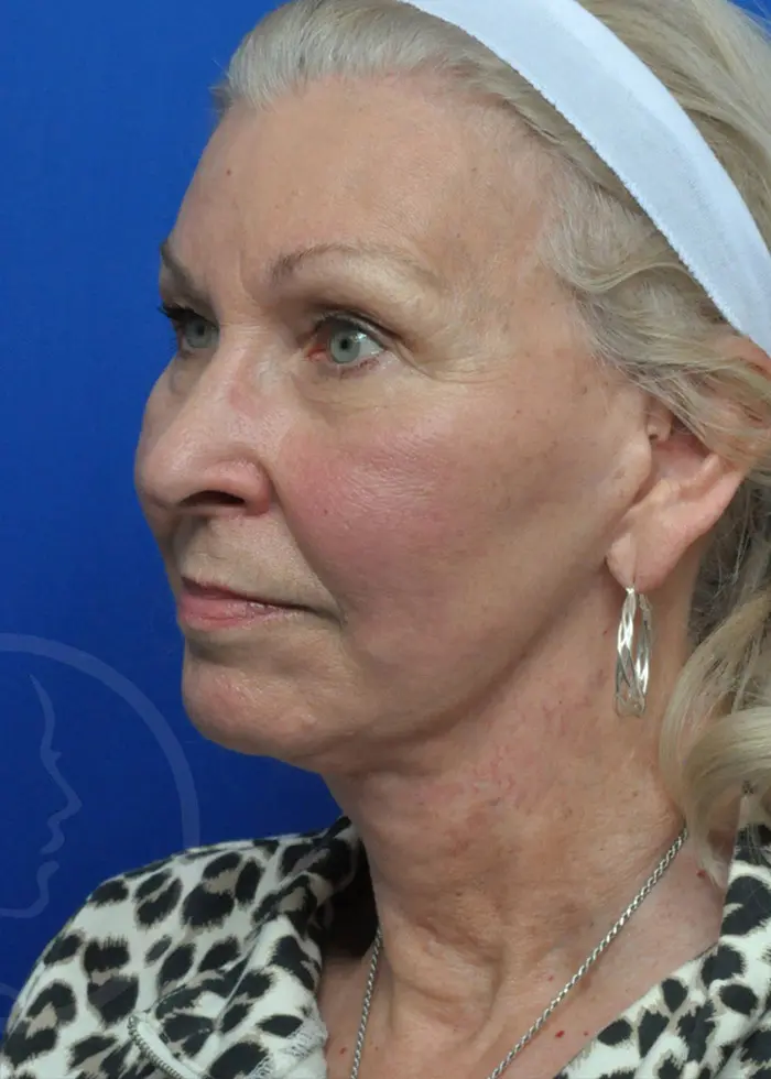 Plastic Surgery Before and After Pictures in Jacksonville, FL - Garcia Facial Plastic Surgery