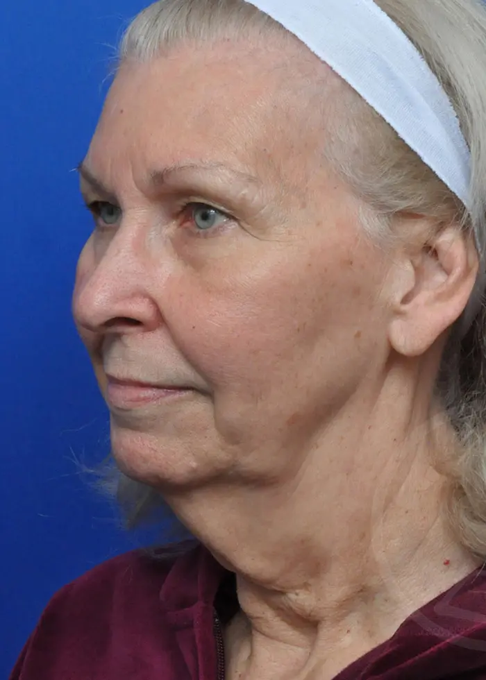 Plastic Surgery Before and After Pictures in Jacksonville, FL - Garcia Facial Plastic Surgery