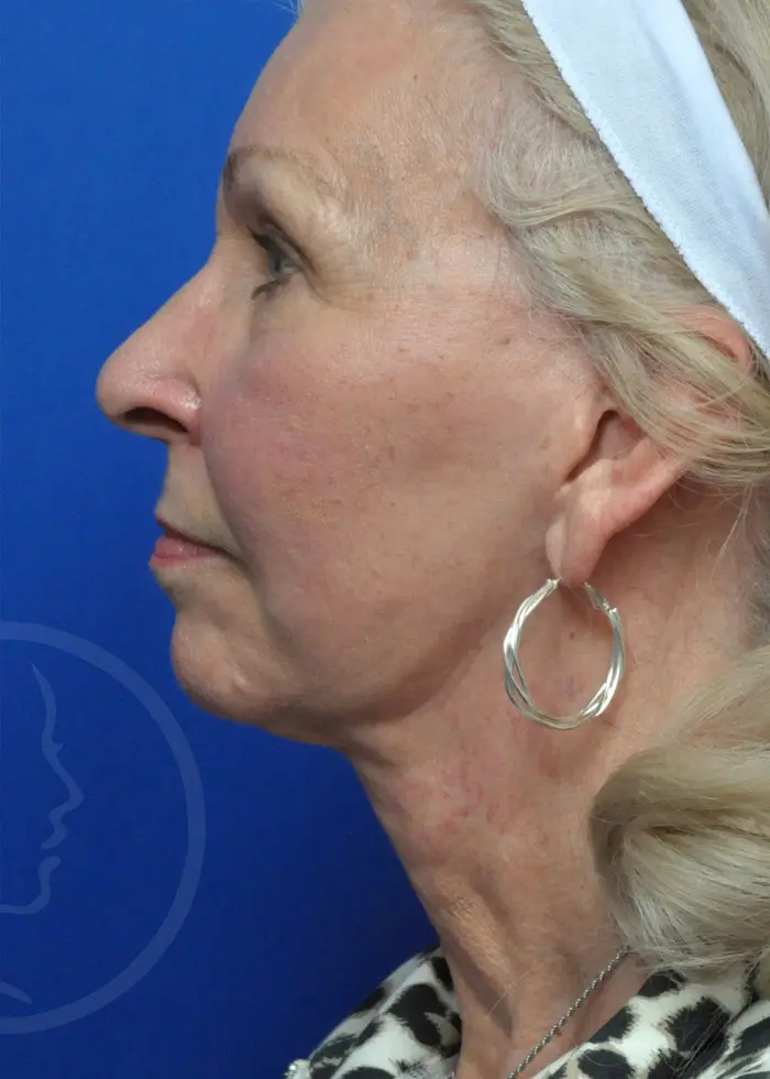 Plastic Surgery Before and After Pictures in Jacksonville, FL - Garcia Facial Plastic Surgery