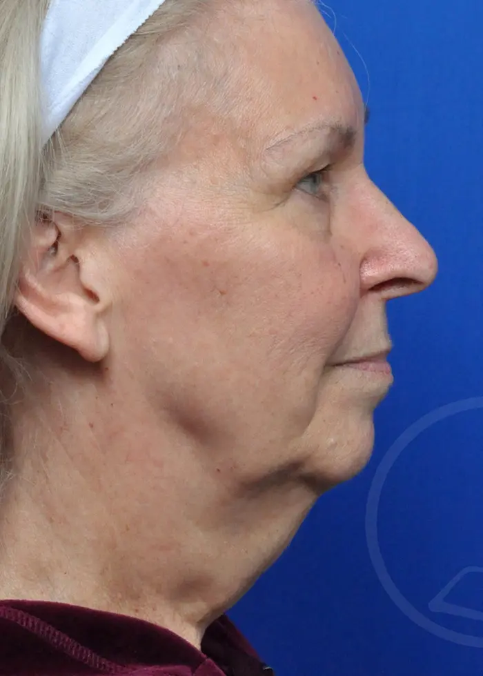 Plastic Surgery Before and After Pictures in Jacksonville, FL - Garcia Facial Plastic Surgery