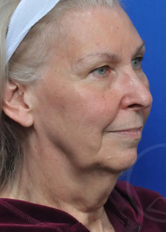 Plastic Surgery Before and After Pictures in Jacksonville, FL - Garcia Facial Plastic Surgery