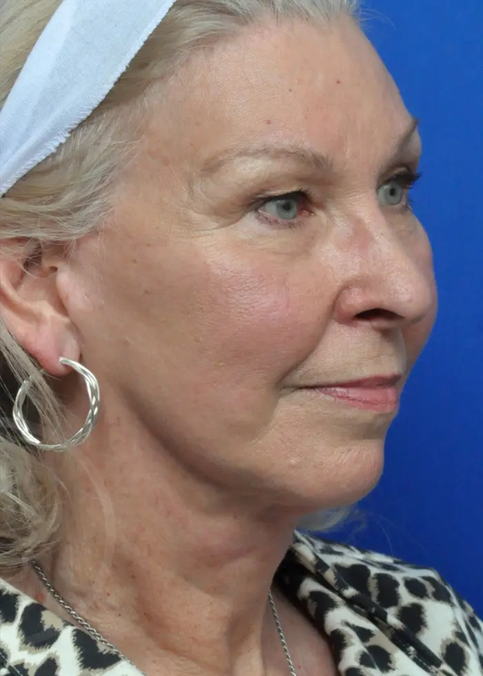 Plastic Surgery Before and After Pictures in Jacksonville, FL - Garcia Facial Plastic Surgery