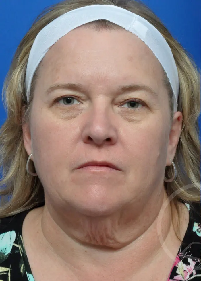 Plastic Surgery Before and After Pictures in Jacksonville, FL - Garcia Facial Plastic Surgery