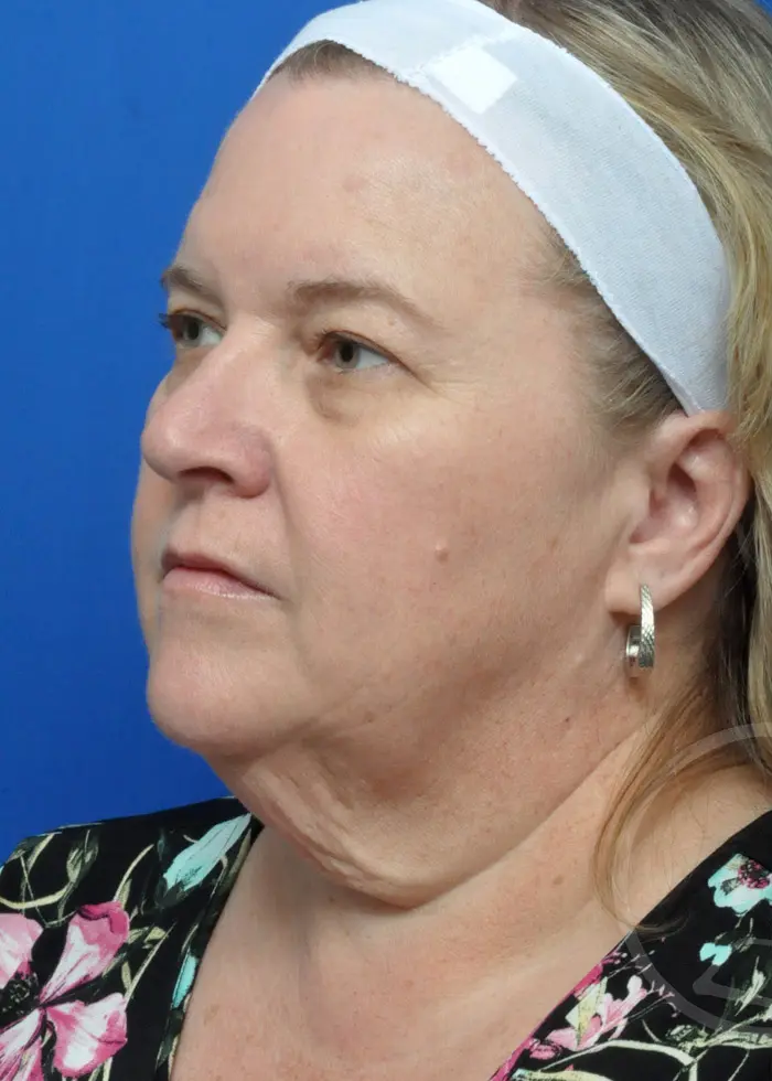Plastic Surgery Before and After Pictures in Jacksonville, FL - Garcia Facial Plastic Surgery