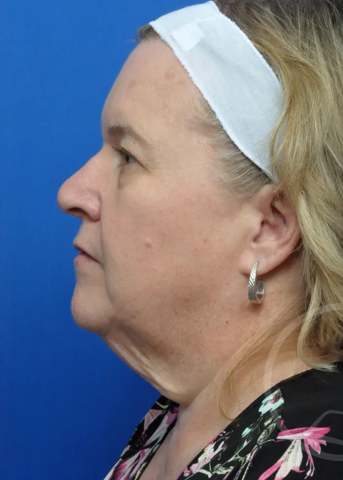 Plastic Surgery Before and After Pictures in Jacksonville, FL - Garcia Facial Plastic Surgery