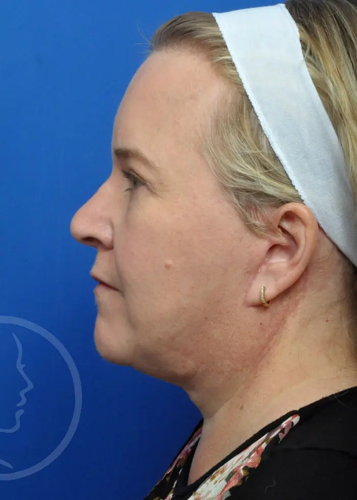 Plastic Surgery Before and After Pictures in Jacksonville, FL - Garcia Facial Plastic Surgery