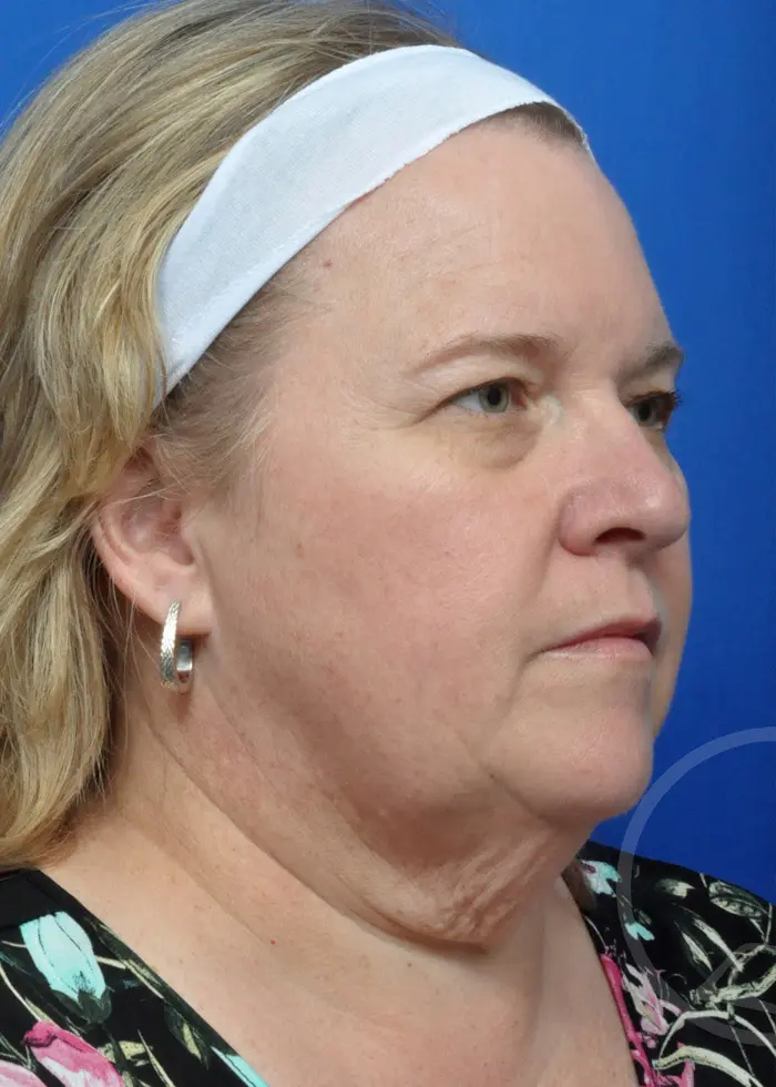 Plastic Surgery Before and After Pictures in Jacksonville, FL - Garcia Facial Plastic Surgery