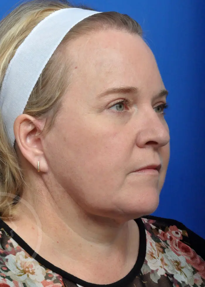 Plastic Surgery Before and After Pictures in Jacksonville, FL - Garcia Facial Plastic Surgery