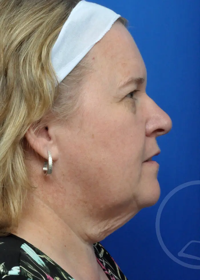 Plastic Surgery Before and After Pictures in Jacksonville, FL - Garcia Facial Plastic Surgery