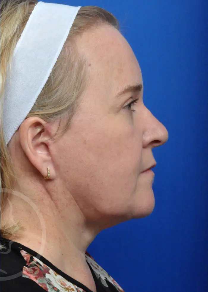Plastic Surgery Before and After Pictures in Jacksonville, FL - Garcia Facial Plastic Surgery