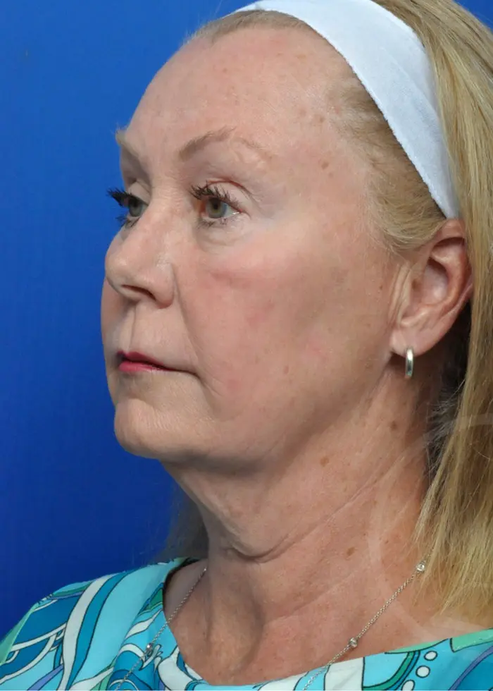 Plastic Surgery Before and After Pictures in Jacksonville, FL - Garcia Facial Plastic Surgery