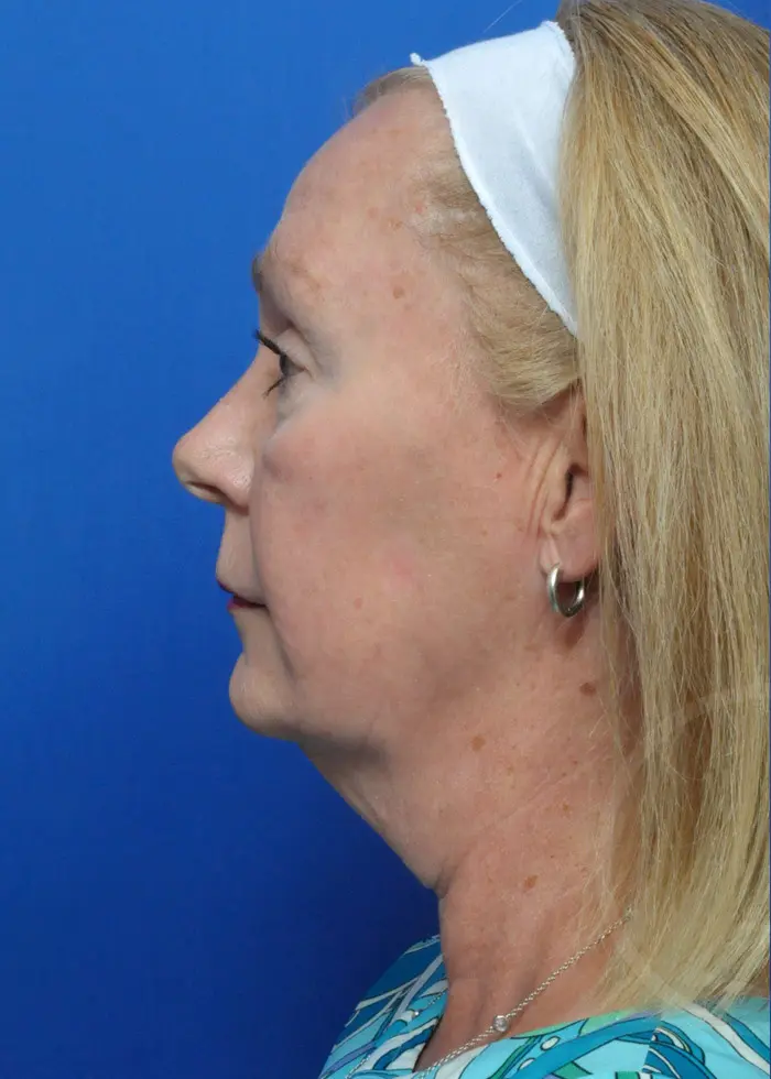Plastic Surgery Before and After Pictures in Jacksonville, FL - Garcia Facial Plastic Surgery