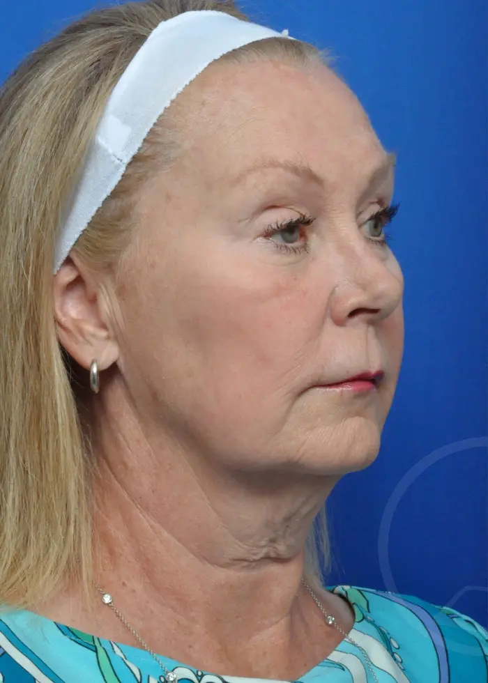 Plastic Surgery Before and After Pictures in Jacksonville, FL - Garcia Facial Plastic Surgery
