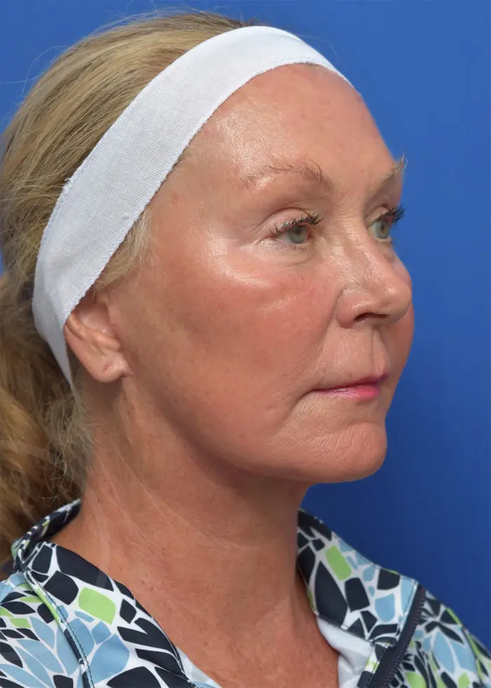 Plastic Surgery Before and After Pictures in Jacksonville, FL - Garcia Facial Plastic Surgery