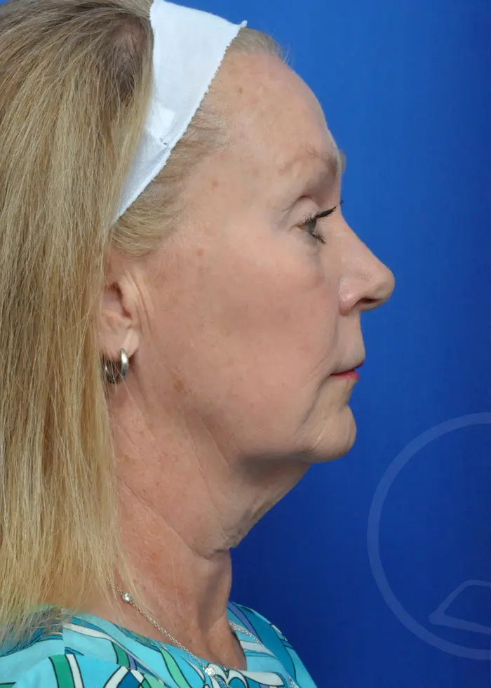 Plastic Surgery Before and After Pictures in Jacksonville, FL - Garcia Facial Plastic Surgery