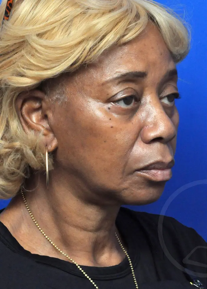 Plastic Surgery Before and After Pictures in Jacksonville, FL - Garcia Facial Plastic Surgery