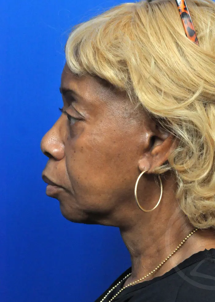Plastic Surgery Before and After Pictures in Jacksonville, FL - Garcia Facial Plastic Surgery