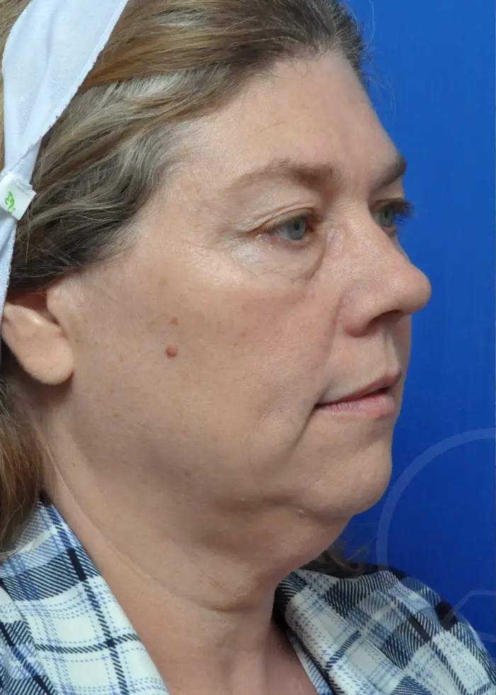 Plastic Surgery Before and After Pictures in Jacksonville, FL - Garcia Facial Plastic Surgery