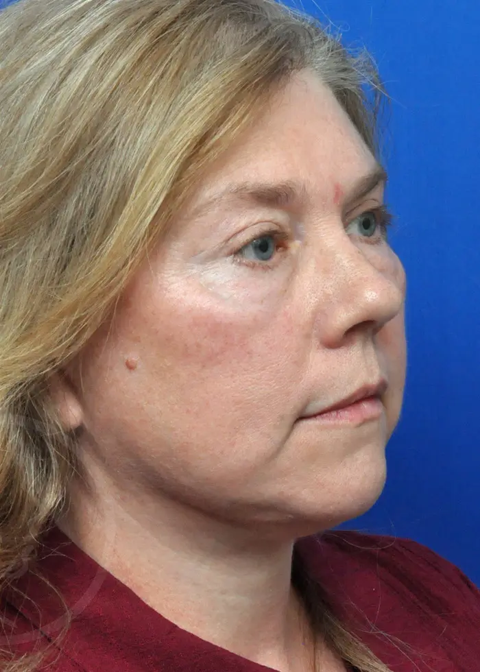 Plastic Surgery Before and After Pictures in Jacksonville, FL - Garcia Facial Plastic Surgery