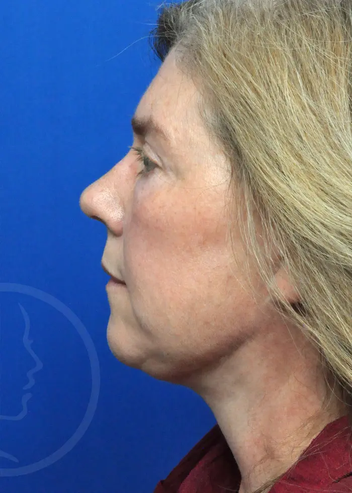 Plastic Surgery Before and After Pictures in Jacksonville, FL - Garcia Facial Plastic Surgery