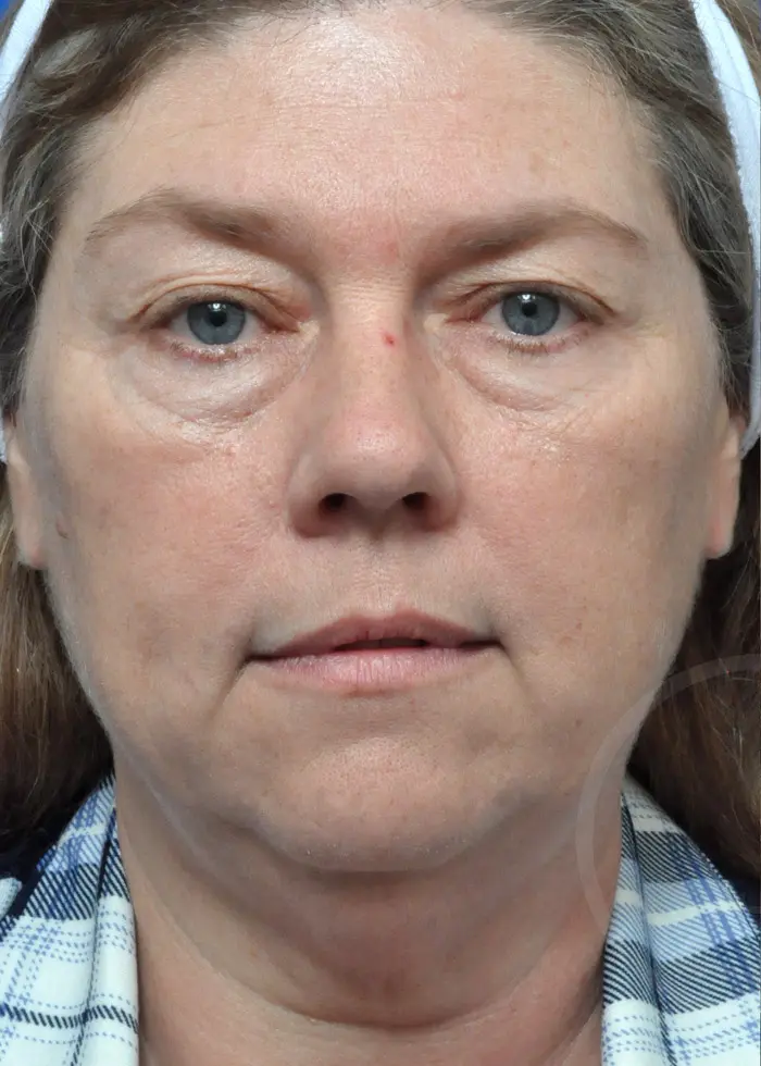 Plastic Surgery Before and After Pictures in Jacksonville, FL - Garcia Facial Plastic Surgery