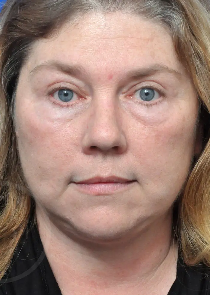 Plastic Surgery Before and After Pictures in Jacksonville, FL - Garcia Facial Plastic Surgery